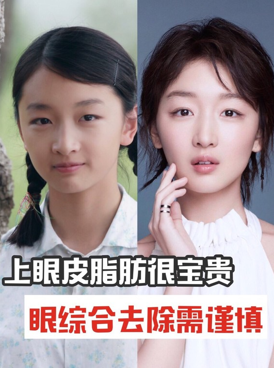 上眼皮脂肪很宝贵眼综合去除需谨慎