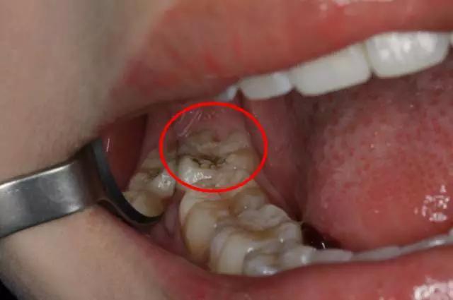 tip 牙博士口腔智齿拔除,应用微创拔牙技术,在患者基本没有痛感的状态