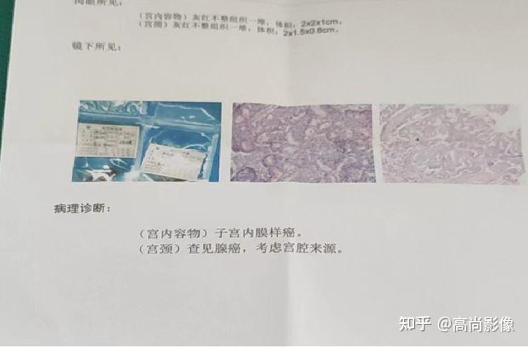 【西安高尚医学影像诊断中心病例】如何认知,早发现子宫内膜癌