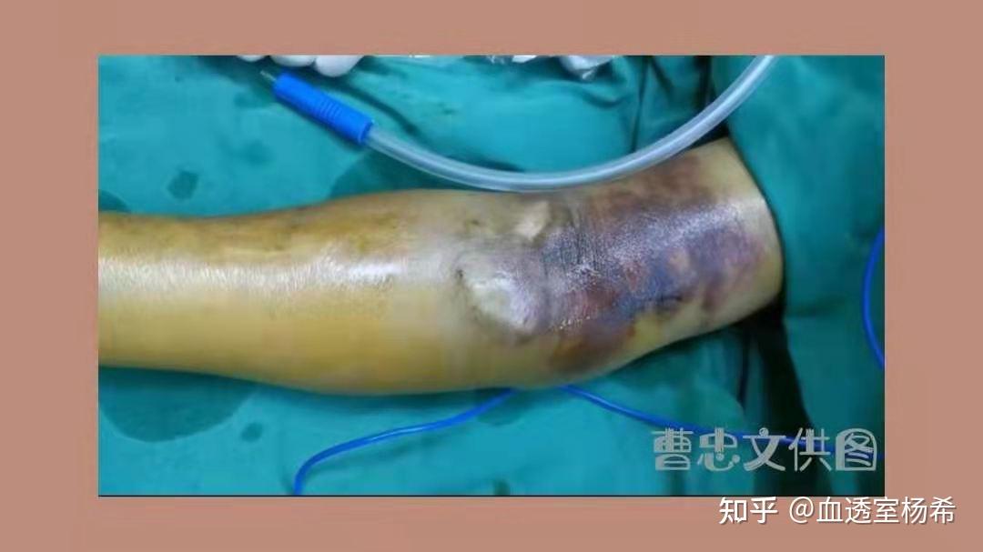 内瘘穿刺一旦误穿肱动脉,血液从破损的血管壁流到周围组织,形成血肿
