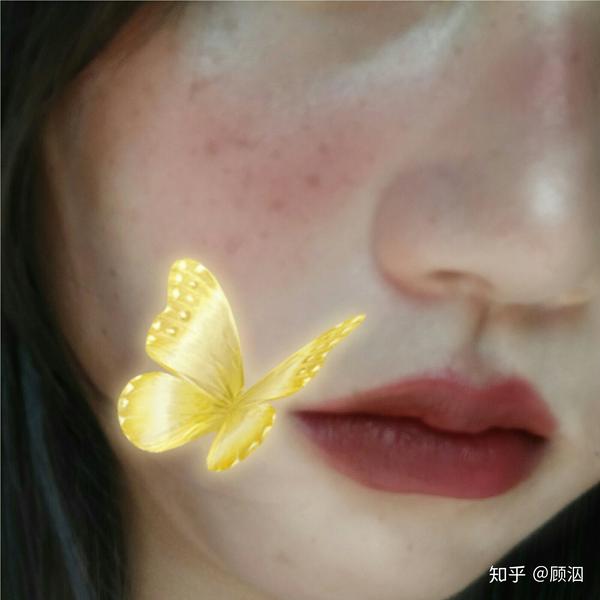 脸上有雀斑是一种什么体验