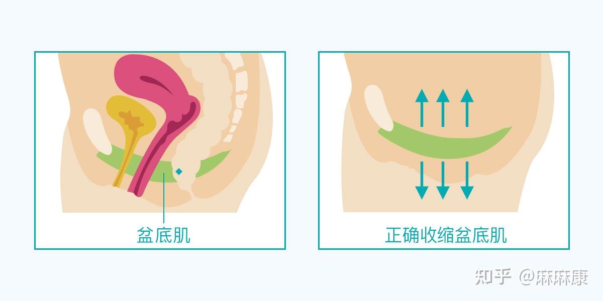 如果想要自检是否阴道膨出,可以尝试蹲下,屏气,用力向下(像生孩子一样