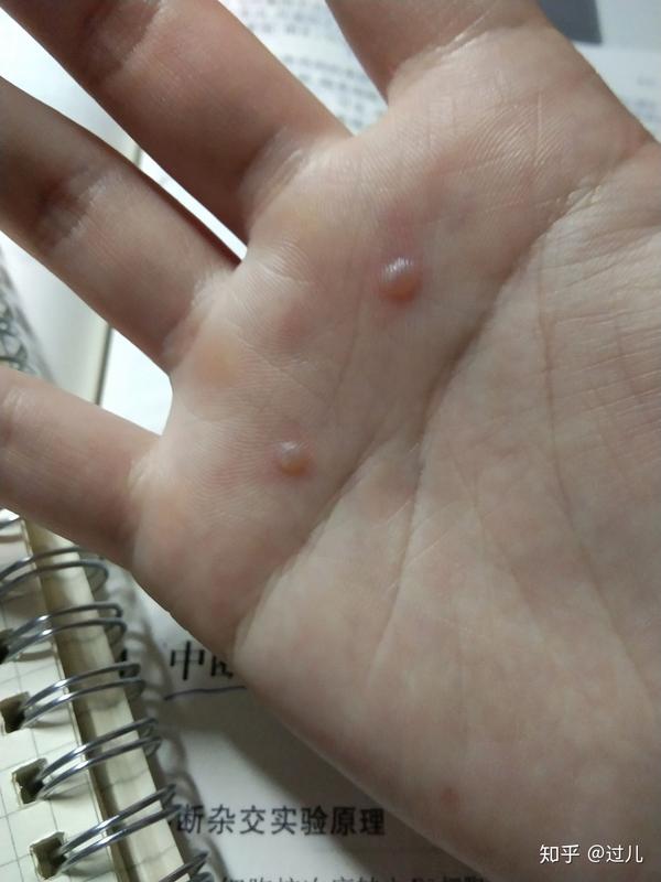 两三个月之前又感染了人乳头状瘤病毒,然后就长了这么多跖疣
