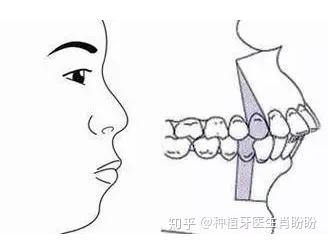 上排前牙直立而且往内倾斜,也会导致牙齿咬合紊乱等