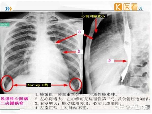 瓣膜病——二尖瓣狭窄