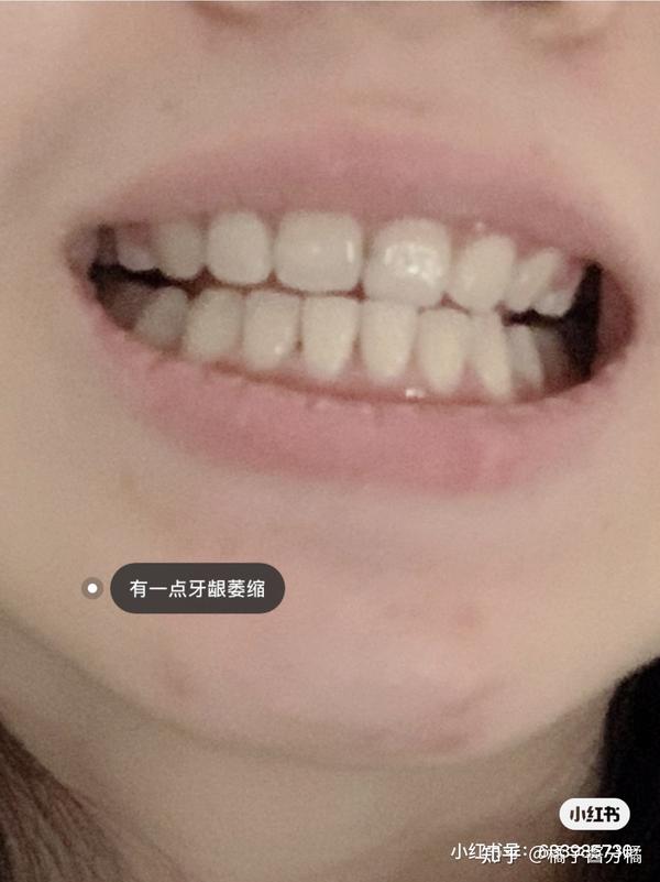 有点显老 2,出现牙龈萎缩和牙龈增生,部分牙齿牙缝变大出现黑三角,后