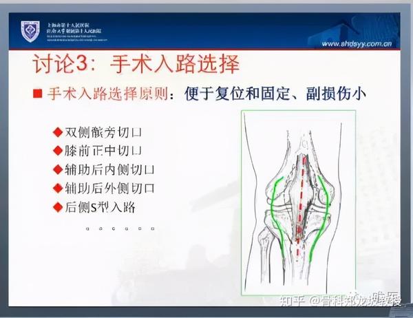 理论与实例丨郑龙坡复杂胫骨平台骨折合并软组织损伤的治疗策略