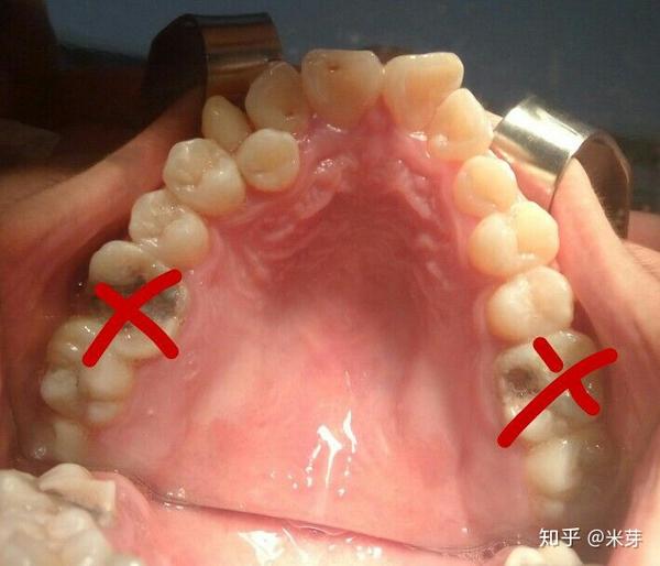 拔去六龄牙,用智齿前种代替磨牙的矫正技术