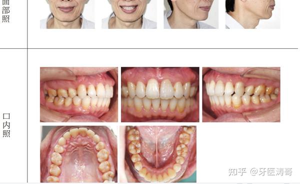 转矩达到侧貌的改善及获得稳定的咬合关系.