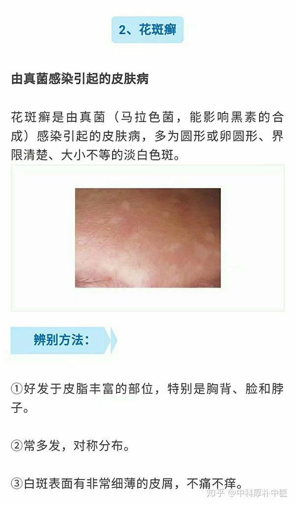 身上长这些白点,会是什么病?