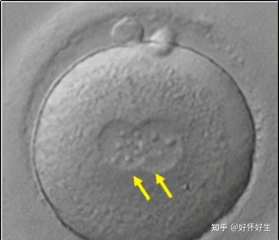 1分钟教你看懂试管婴儿囊胚报告