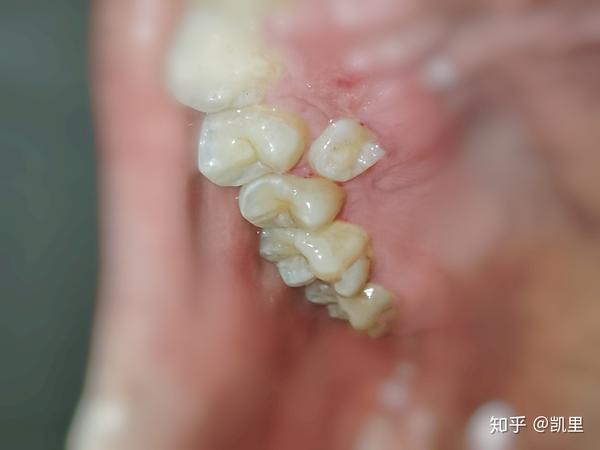 这种牙齿能不能拔掉