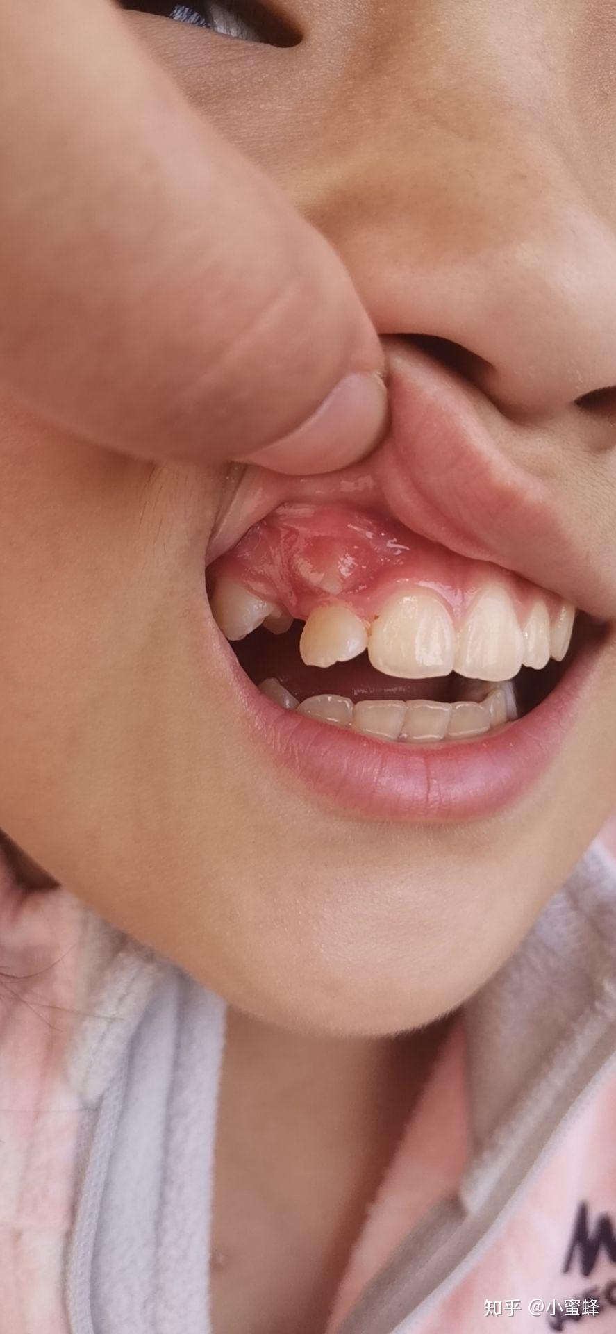 十岁孩子牙龈上长牙齿怎么办