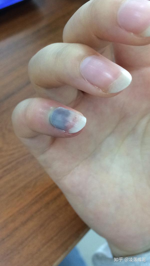 手指被车门夹伤之后.