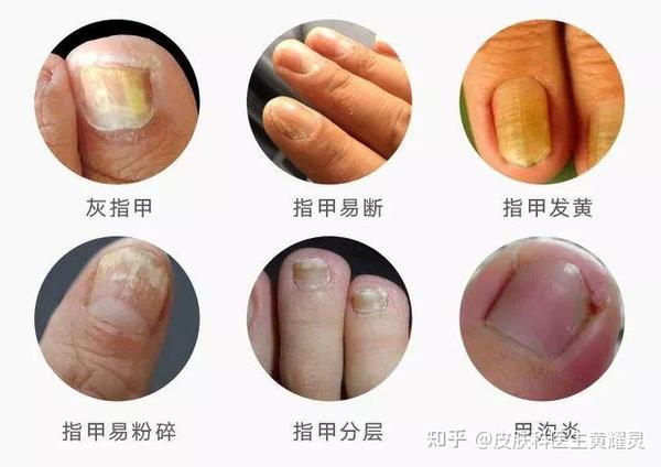 导致灰指甲出现的原因有很多真菌性灰指甲病因主要分为以下几种