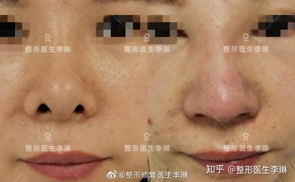 漏鼻孔,鼻翼缘内缩怎么办?