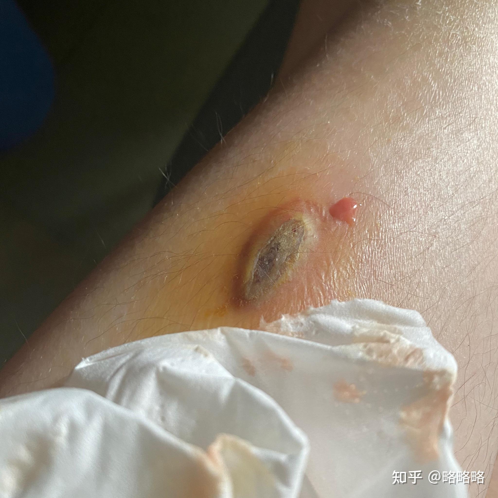 骑车摔伤20天了伤口结痂了但是有一个有一点流脓能接种新冠疫苗吗
