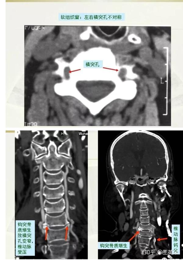 交感神经型 x线表现    颈椎旋转移位,出现双边,双突症,椎体不稳 ct