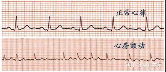 心房颤动简称房颤,是最常见的心律失常.