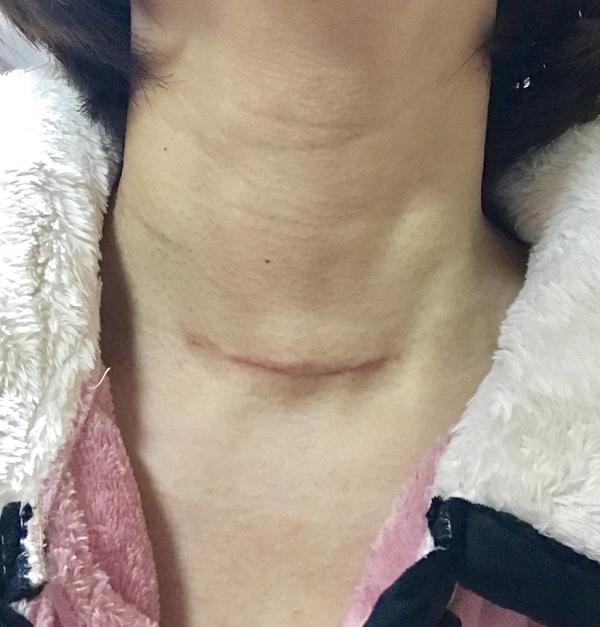 果断手术,然后脖子留下了一条非常难看的疤痕