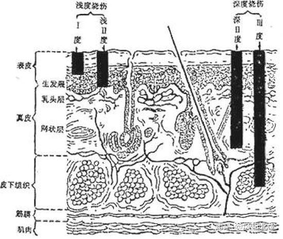 烧伤的面积