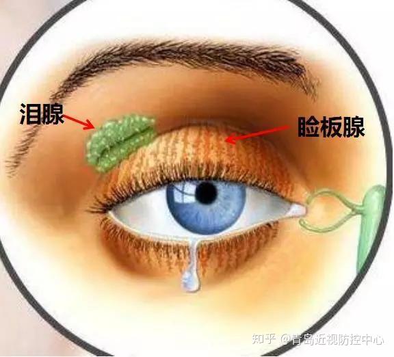 缺水:泪腺分泌眼泪水不足,难以维持眼球表面的湿润 缺油:睑板腺功能