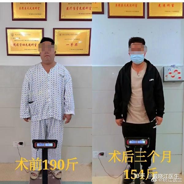 190斤糖尿病肥胖患者甩重30多斤减重手术对其血糖控制的积极意义