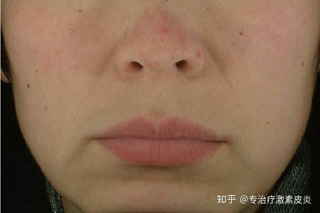症状主要体现在双侧脸颊,鼻部通常不会这么潮红;而玫瑰痤疮的皮损则多
