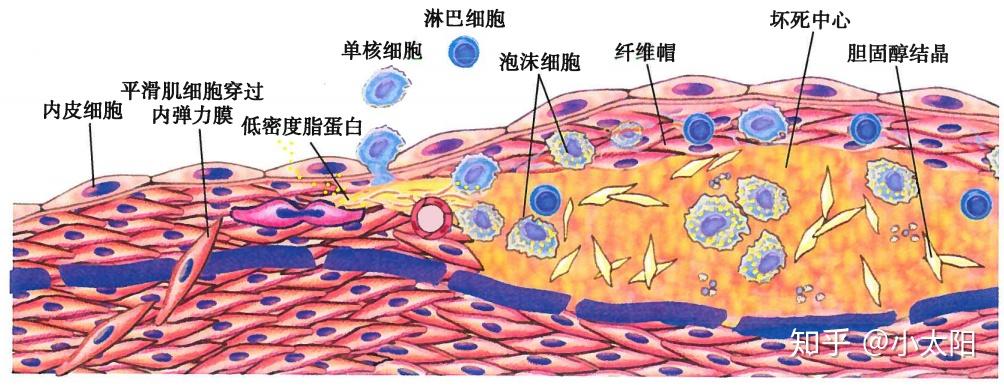 动脉粥样硬化示意图