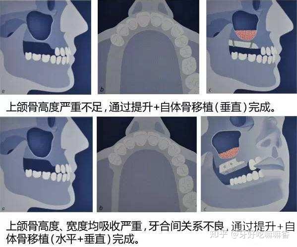 它可以保证我们的美观,不过如果牙槽骨萎缩,没有植骨,那就会有缝会