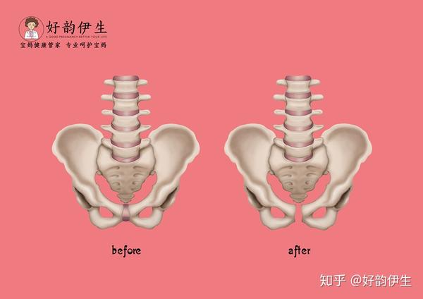 产后耻骨联合分离怎么办?