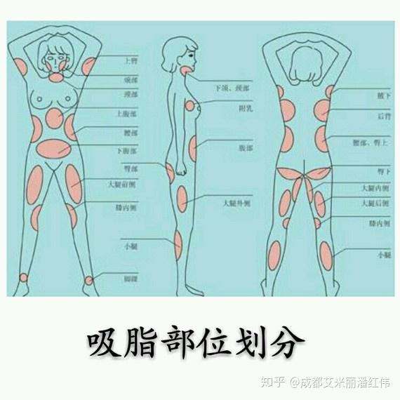 艾米丽潘红伟吸脂减肥真的好可怕!胖子千万不要做!谨点