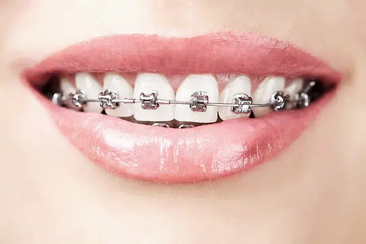 想正畸舌侧隐形陶瓷自锁这么多种牙套该怎么选