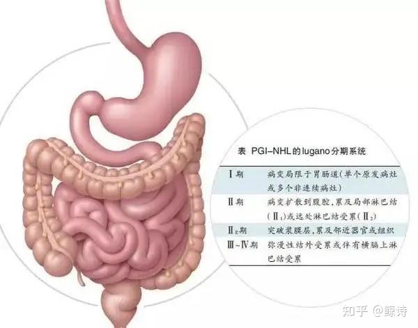 中西医治疗慢性结肠炎