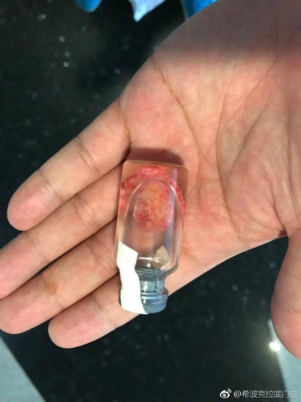 最后切下的大腿肿块