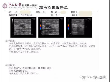 乳腺结节会不会恶变?别担心,记住这几个分辨方法