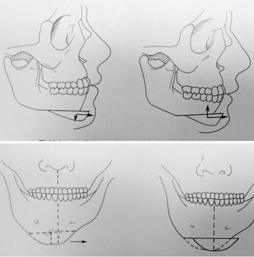 颏成形和垫下巴有什么区别?应该怎么选?