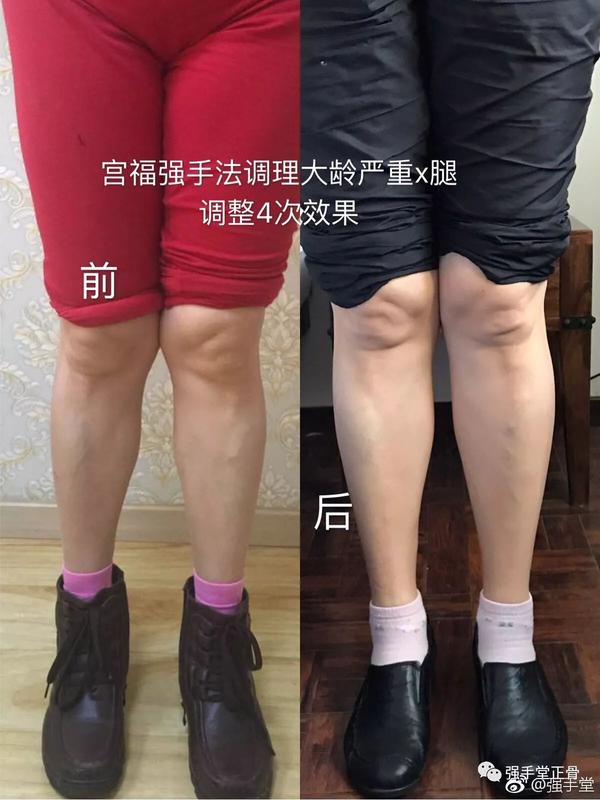 史上最复杂的xo型腿基本解决方案