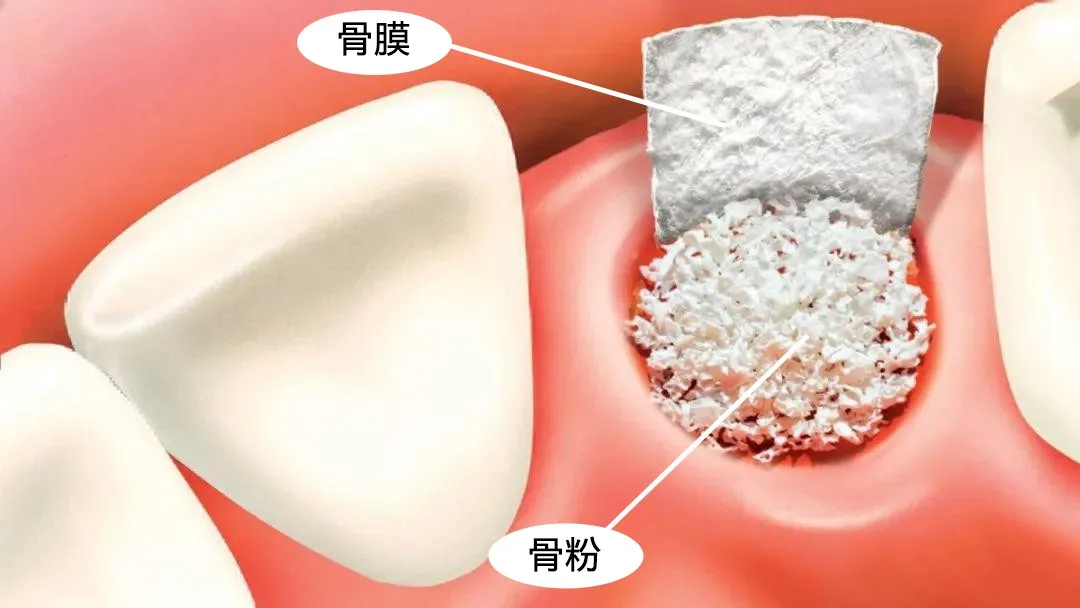 拔牙后如果不种植牙齿是否需要植入骨粉