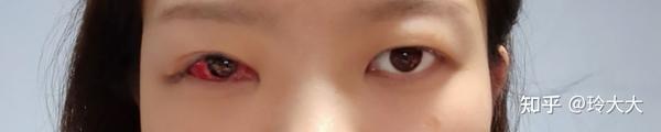 26岁女生做完斜视手术后的感受