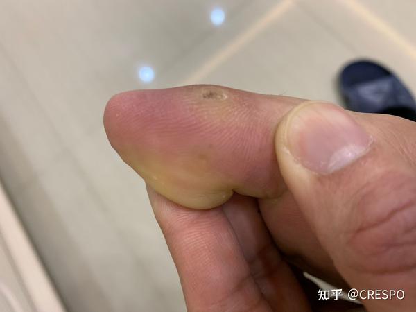 是冬季穿不透气的鞋子 感染起来很快 脚底开始有透明的硬硬的小水泡