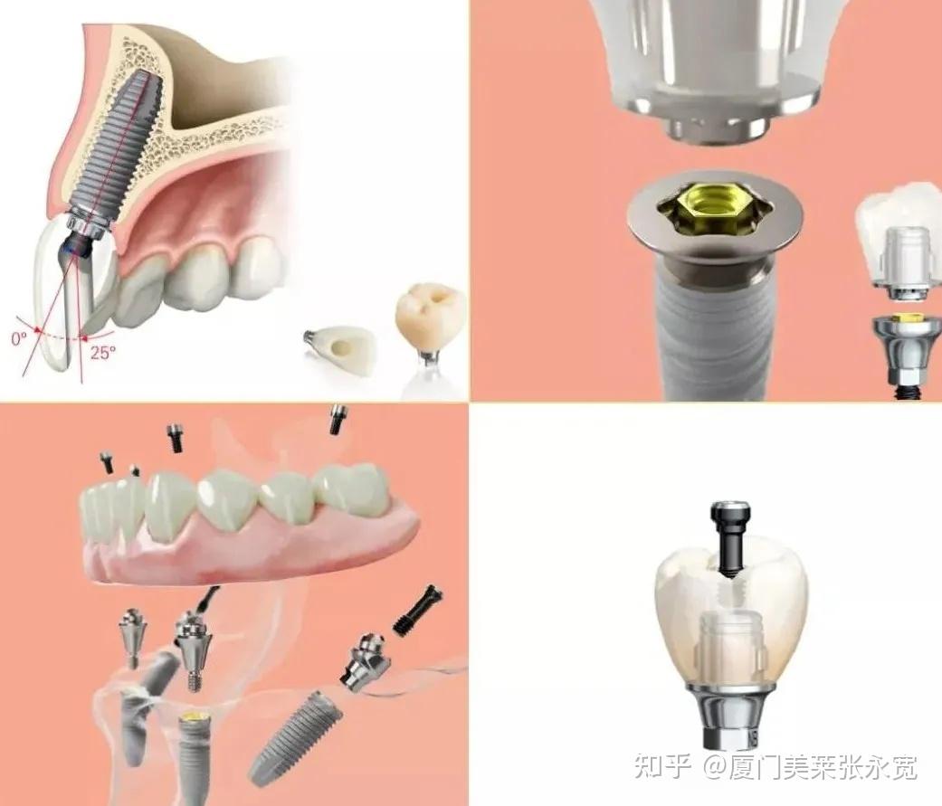 人工牙根完全融合后,就可以给人工牙根上安装上定制牙冠,至此,种植牙