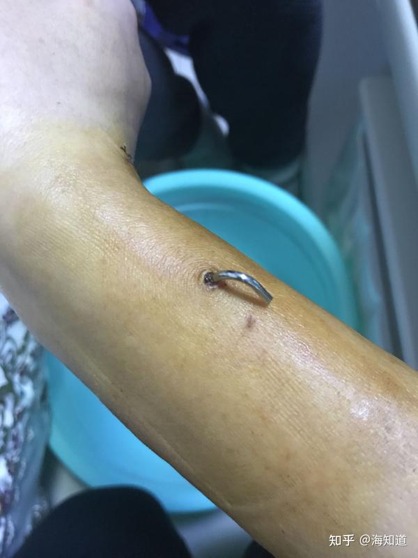 期间每天要换一次药 打两瓶点滴 微创手术创口比较小  骨髓道缝了四针