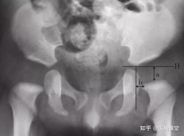 20张图掌握髋关节x线检查的各种线与角