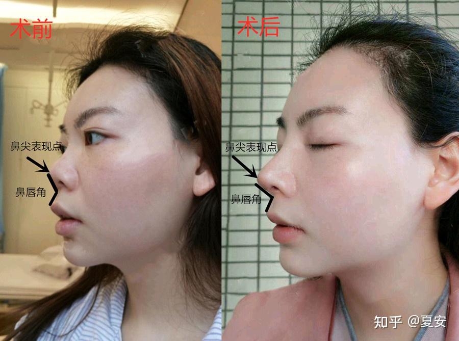 案例二,假体挛缩