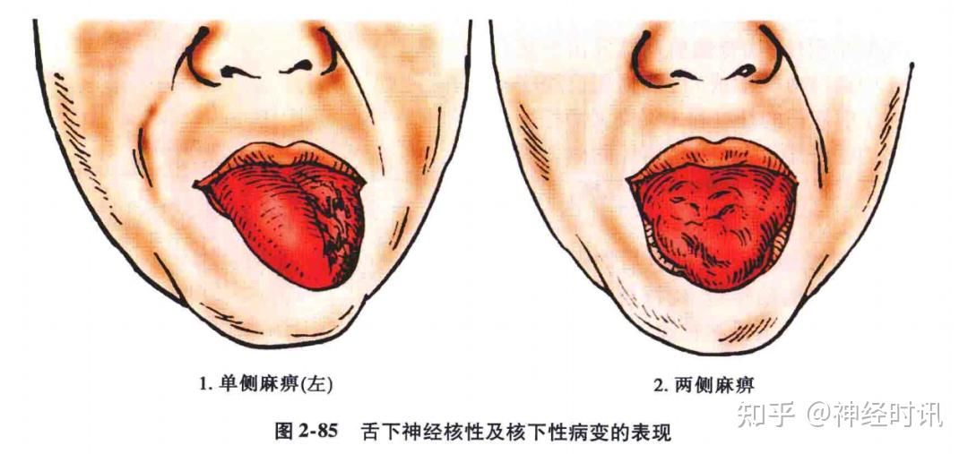 纤维损伤:当一侧舌下神经核及其发出的纤维损害时,可出现同侧舌肌瘫痪