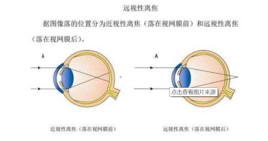 根据竞争性近视离焦理论:给小鸡眼前加正球镜模拟远视,焦点落在视网膜