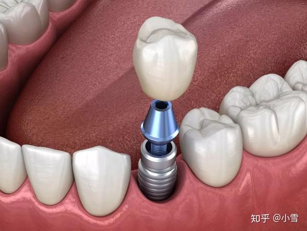 邯郸贝洁口腔种植牙过程分为几个步骤