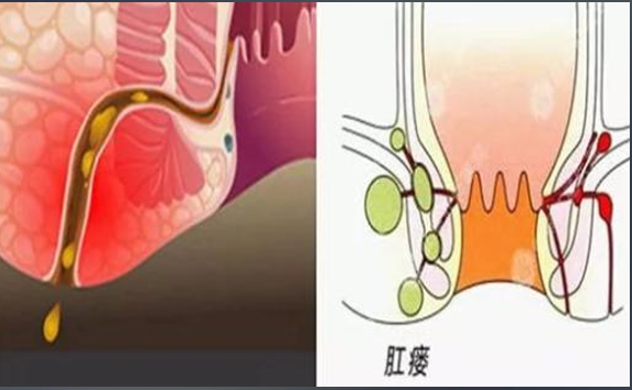 不要逃避治疗 肛裂反复感染易病变