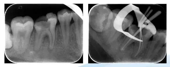 当怀疑是牙龈息肉时,可自蒂部将其切除,见出血部位在患牙邻面龋洞龈壁